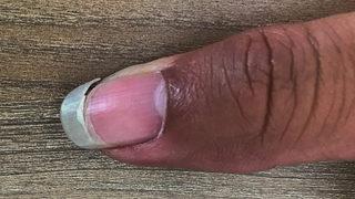 Demir eksikliği her 3-4 kadından birinin sorunu! Ciddi hastalıkların ilk sinyali olabilir