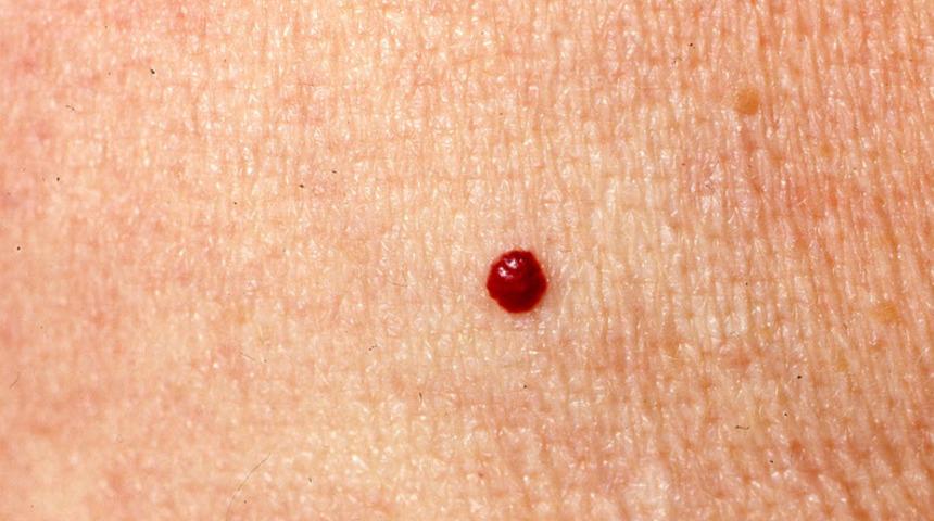 Kırmızı ben deyip geçmeyin! Sizin de vücudunuz da var mı?