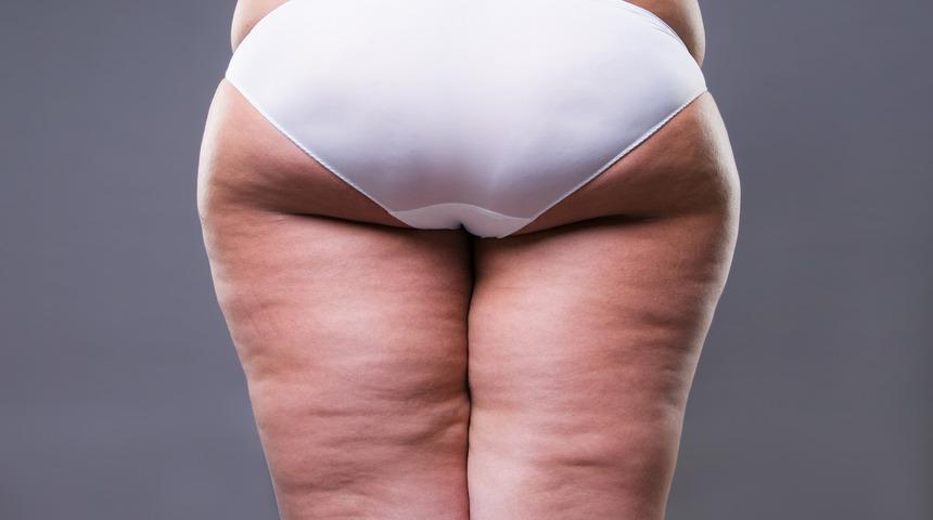 Liposuction zayıflama yöntemi değildir 