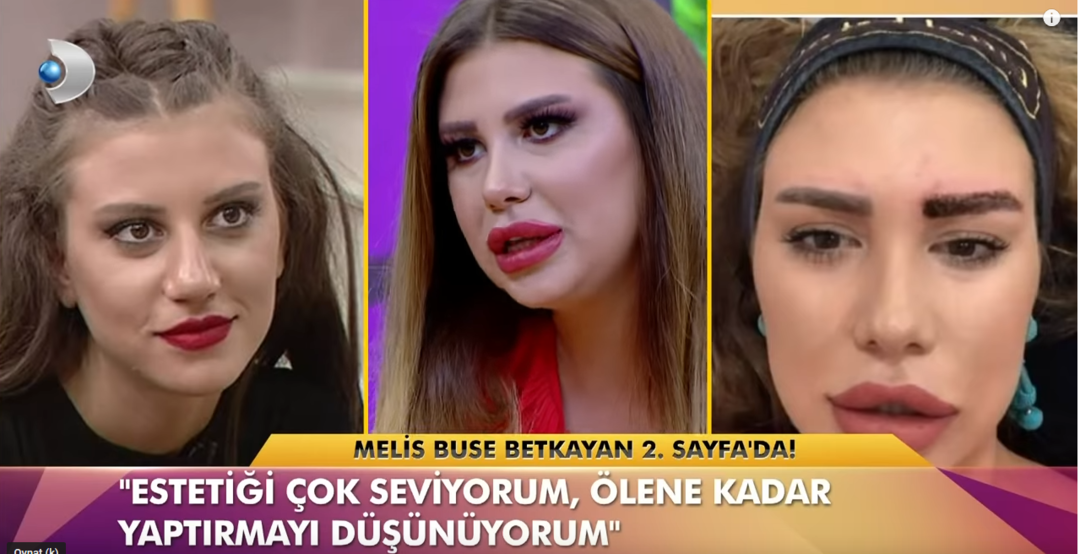 Melis Buse Betkayan'ın estetikli hali şaşırttı