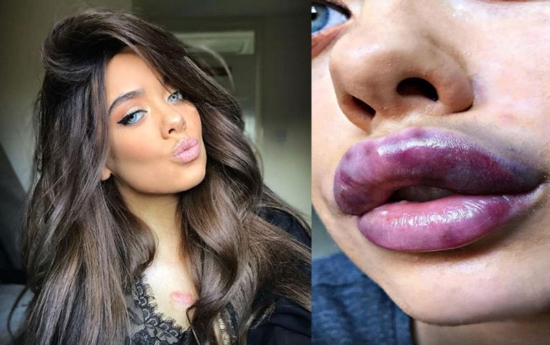 Korkun&ccedil;! &Uuml;nl&uuml; yıldızın dudağı &ouml;l&uuml;yor