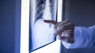 Göğüs cerrahisinde lokal anestezi ile yapılan ameliyatların avantajları nelerdir?