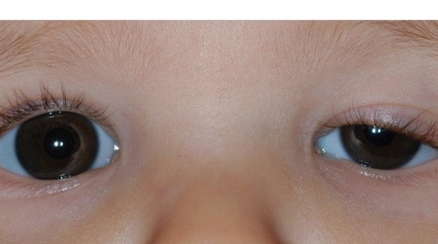 &Ccedil;ocuklarda g&ouml;z kapağı d&uuml;ş&uuml;kl&uuml;ğ&uuml; &ouml;nemsenmeli