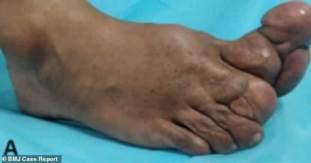 13191758-7000921-Doctors_have_released_photographs_of_a_man_s_foot_after_he_was_b-m-4_1557224051148