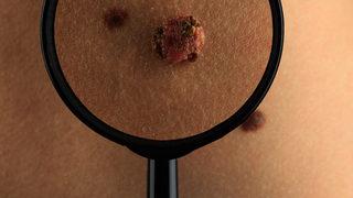 Kadınlar arasında bir güzellik sembolü oldu ama benler kanser habercisi olabilir! Bunlara dikkat