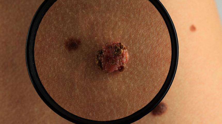 Kadınlar arasında bir güzellik sembolü oldu ama benler kanser habercisi olabilir! Bunlara dikkat