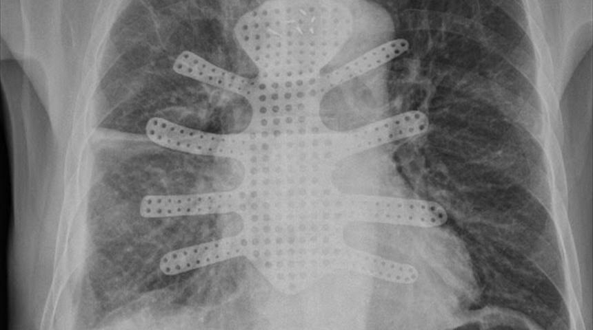 Göğüs kafesini saran tümörden yapay göğüs kafesiyle kurtuldu