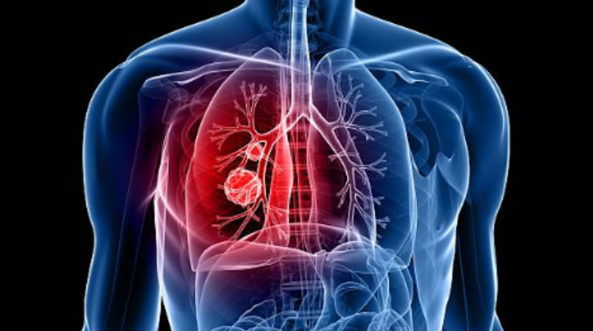 K&uuml;&ccedil;&uuml;k h&uuml;creli akciğer kanseri tedavisinde yeni umut