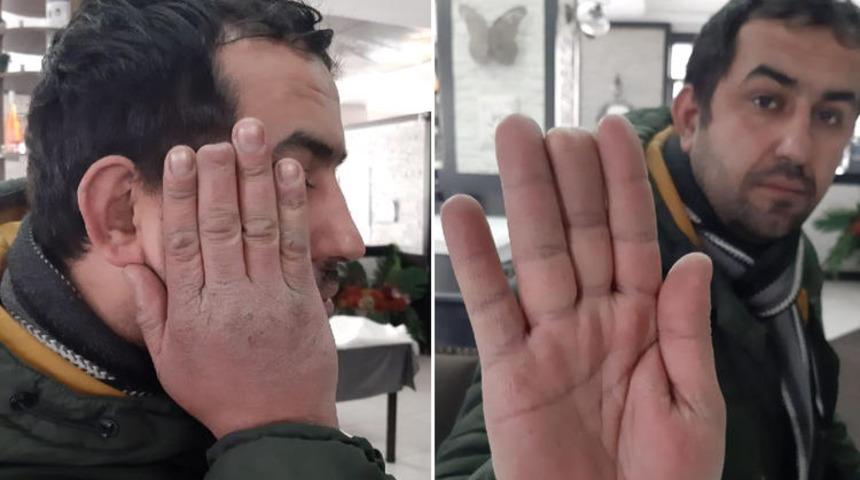Elinde kopan parmağı ile hastane hastane gezdi! Yeni gelişme