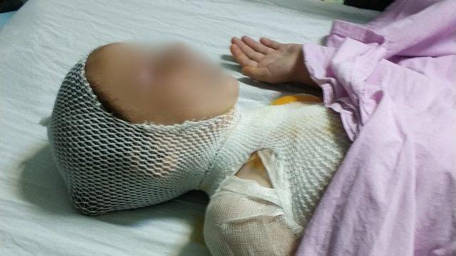 Kaynatılırken taşan süt çocuğu hastanelik etti