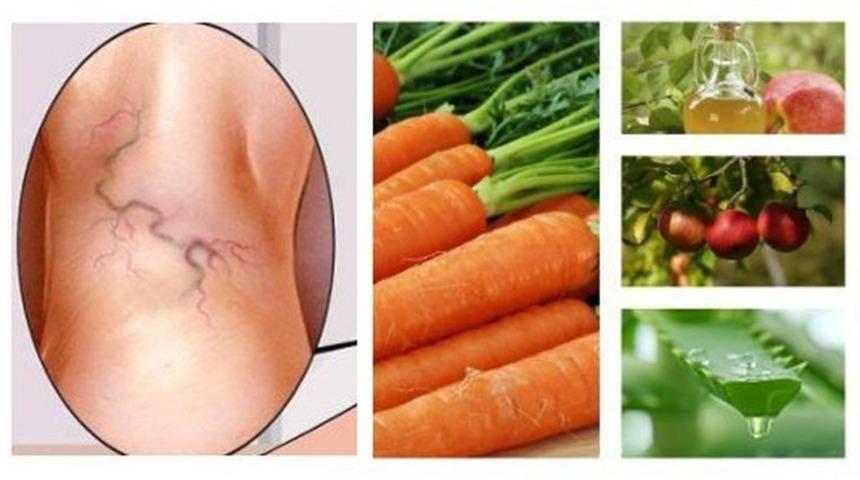 Varislerinizi bu doğal y&ouml;ntemle tedavi edin