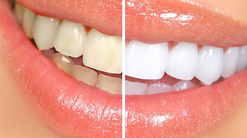 Sivilceleri kurutuyor, dişleri beyazlatıyor: Oksijenli suyun hi&ccedil; bilmediğiniz kullanım alanları