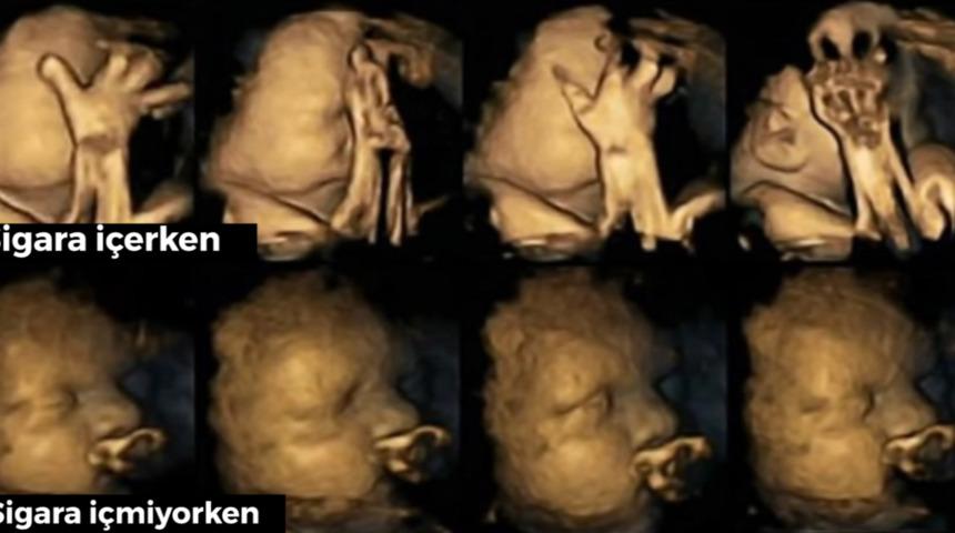 Hamileyken Sigara İ&ccedil;enlerin Bebeklerine Verdiği Zarar Fotoğraflandı!