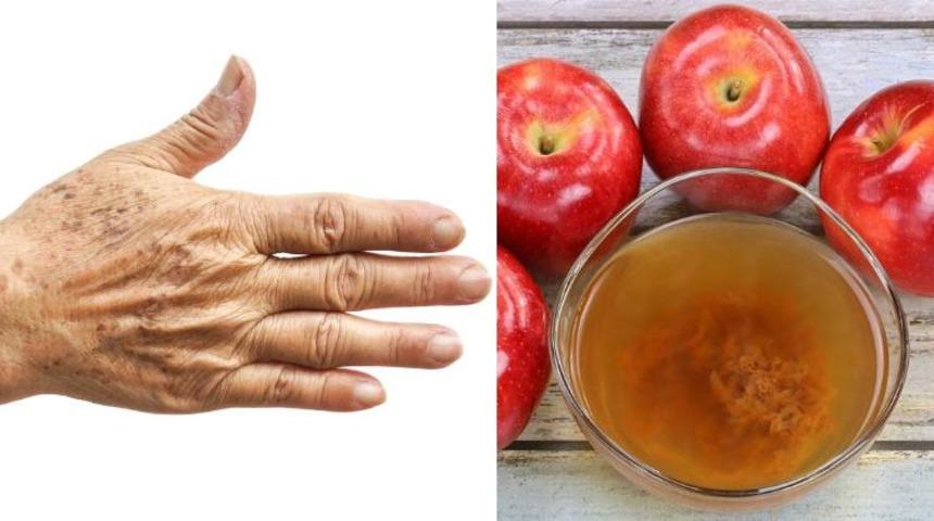 Mutfaktaki malzemelerle g&uuml;neş lekelerinizden kurtulun