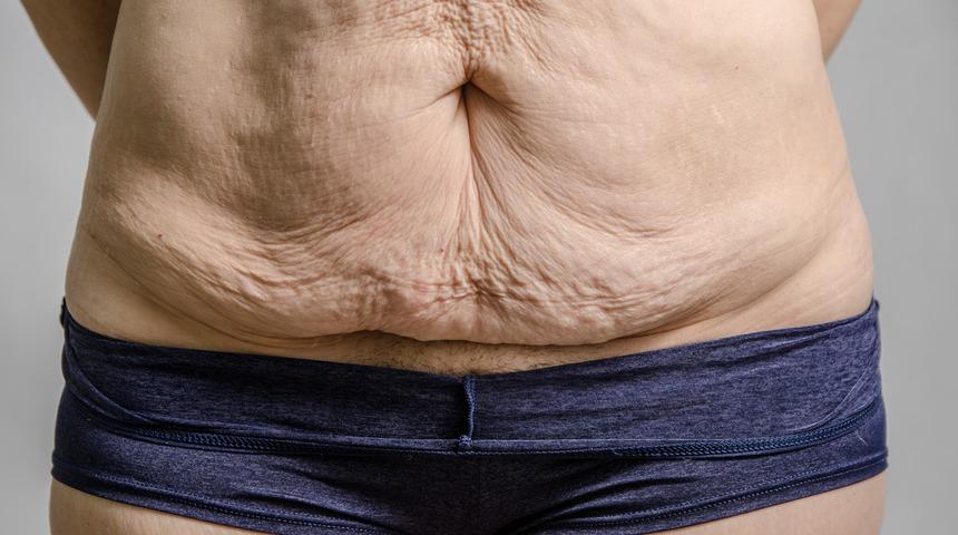 Ani kilo kaybı sonrası sarkan deri için tek yöntem...