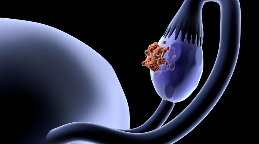 Bu test yumurtalık kanserinin takibi açısından oldukça önemli! İşte CA-125 hakkında bilmeniz gerekenler