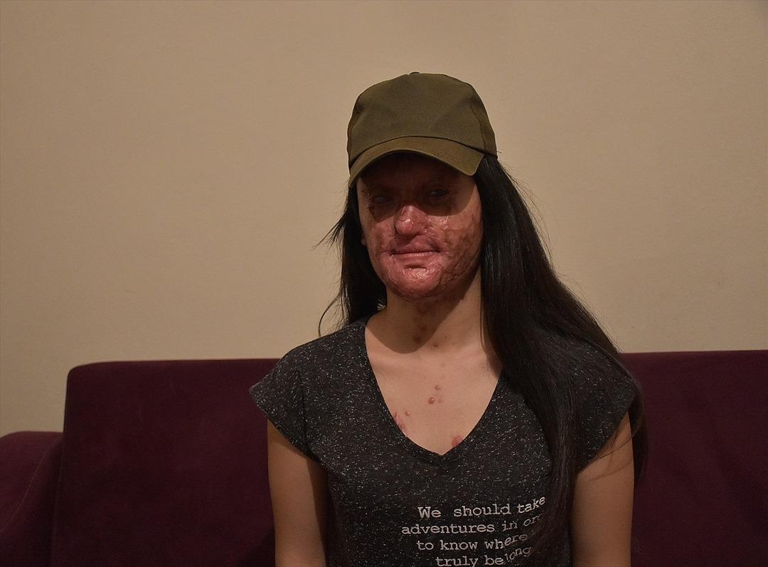 Asit saldırısına uğramıştı! Berfin eski y&uuml;z&uuml;ne kavuşmak i&ccedil;in tedaviye başladı