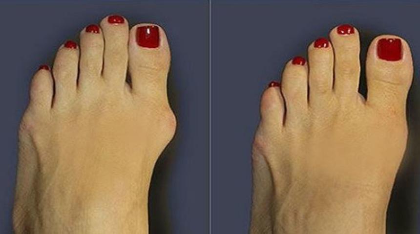 Başparmak &ccedil;ıkıntısı (bunyon) nedir? Nasıl tedavi edilir?