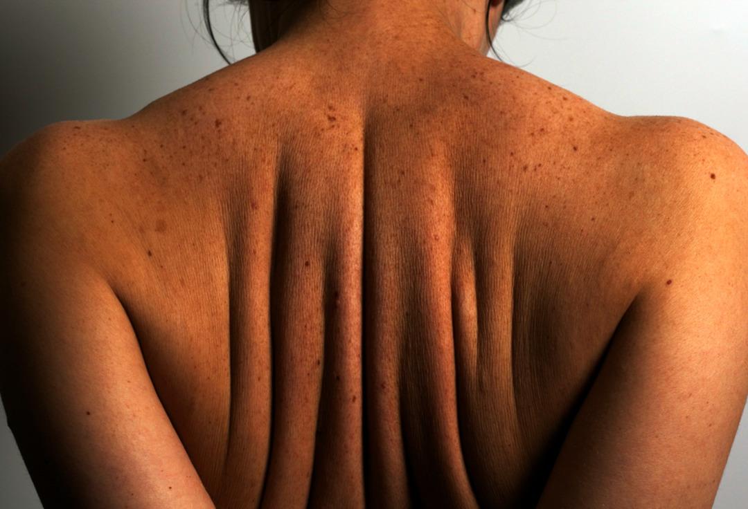 Cildinizdeki koyu lekeleri &ccedil;ıkarmanın doğal yolları