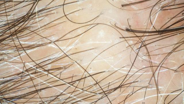 Papayadan ananasa! Saç dökülmesini ve kepek oluşmasını önleyecek mucize öneriler