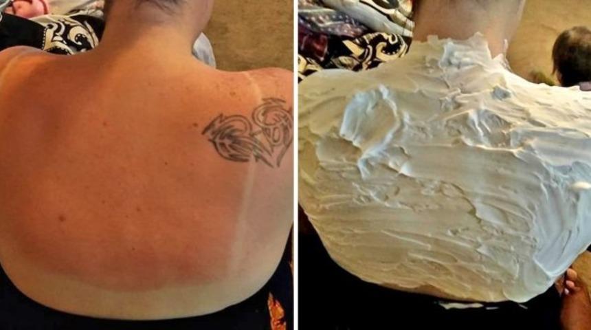 Kadının g&uuml;neş yanığına bulduğu &ccedil;&ouml;z&uuml;m sosyal medyada olay oldu! 