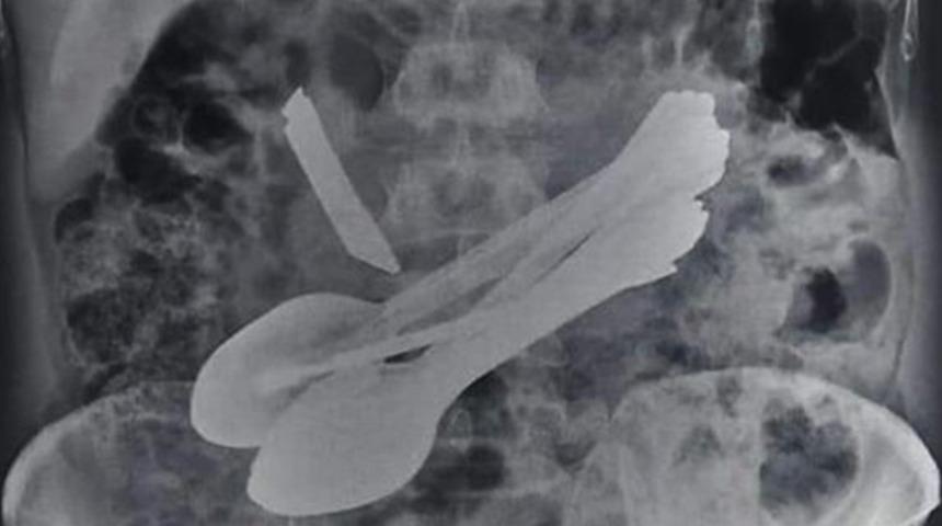 Hindistan'da bir adamın midesinden kapı kilidi, kaşık, tornavida, diş fır&ccedil;ası ve bı&ccedil;ak &ccedil;ıktı