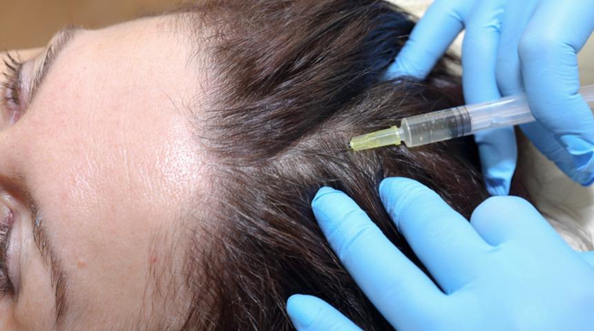 Sa&ccedil; D&ouml;k&uuml;lmesinde En Son Trend Sa&ccedil; Dolgusu