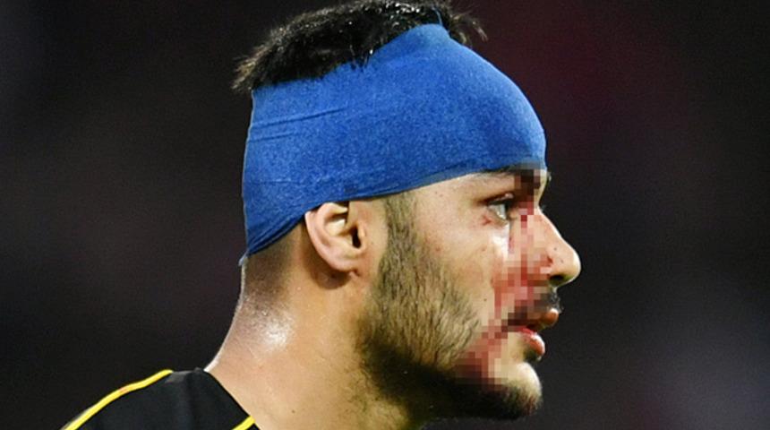 Milli futbolcumuzun şok g&ouml;r&uuml;nt&uuml;s&uuml;! Kanlar i&ccedil;inde kaldı