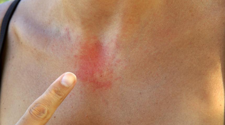 Kurdeşen nedir? Kurdeşen nasıl ge&ccedil;er? Kurdeşen tedavisinde ne &ouml;nemlidir? Kurdeşen sebepleri nelerdir?