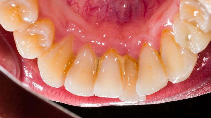 Hamilelikte yaşanan diş eti problemleri erken doğuma sebep olabilir!