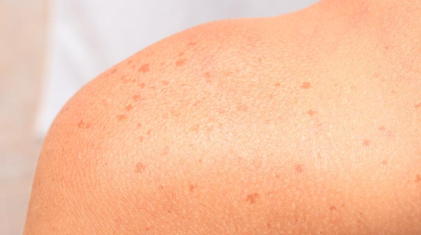 Yaz aylarında daha sık g&ouml;r&uuml;l&uuml;yor! G&uuml;zelleşme r&uuml;yasında melazma korkusu 