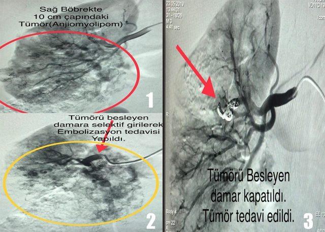 Kütahya’da böbrek tümörü ameliyatsız temizlendi