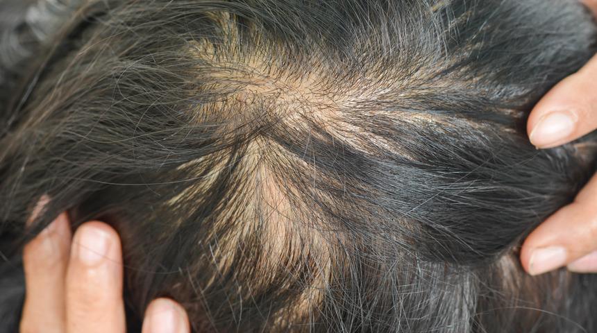 Tüm dünyada kullanılıyor! Dökülen saçlarınız kaderiniz olmasın