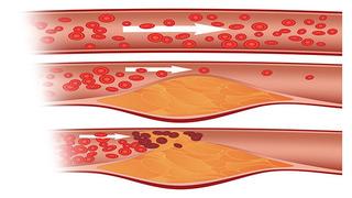 Kolesterolünüzü Düşürmenize Yardımcı Olacak 6 Süper Yiyecek 