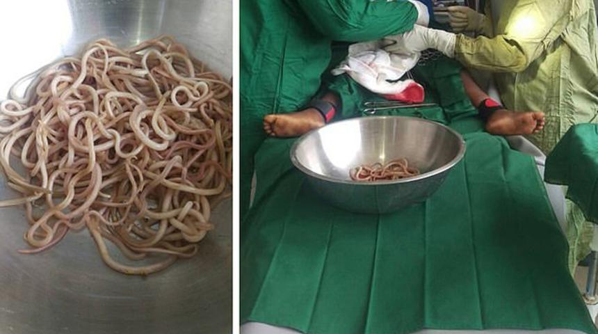 4 yaşındaki çocuğun bağırsaklarından bir tabak kurt çıktı