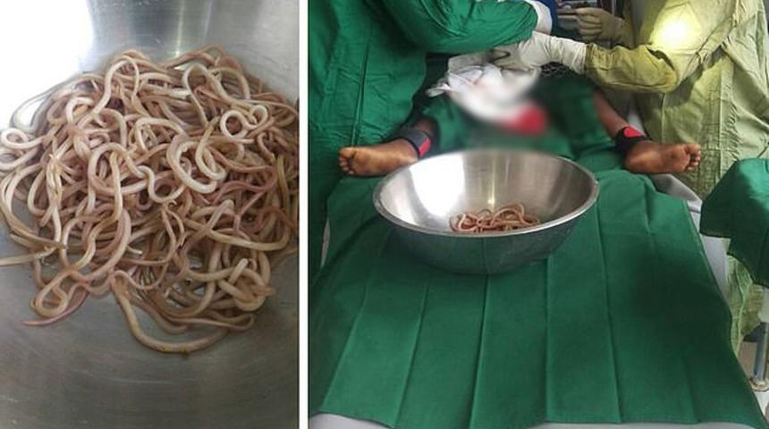 4 yaşındaki &ccedil;ocuğun bağırsaklarından bir tabak kurt &ccedil;ıktı