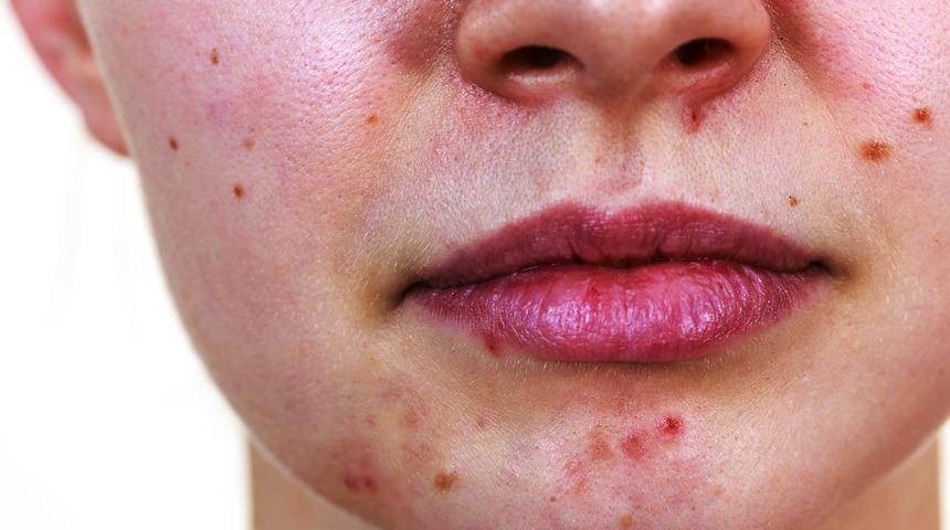 Yüzdeki sivilceler artık tarih oluyor! 