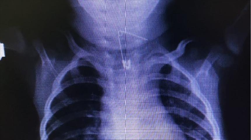 Yemek borusundan çengelli iğne çıkardılar