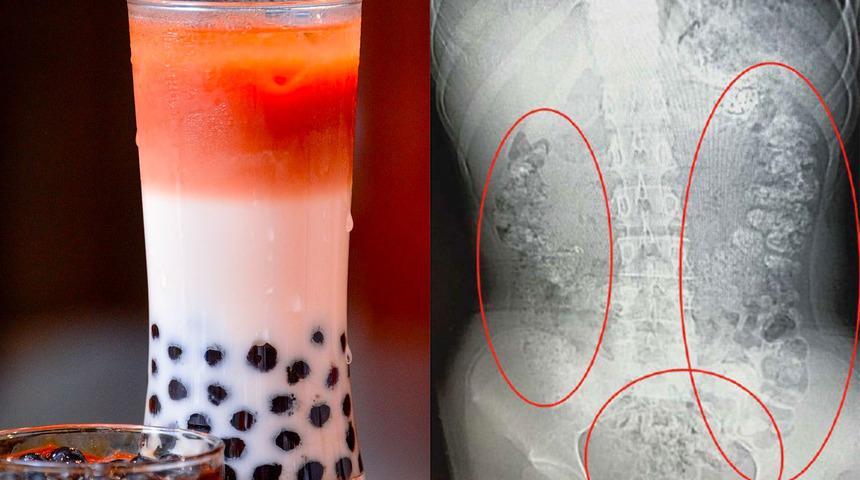 Kabızlık şikayetiyle gitti! Midesinde 100 tane bulundu