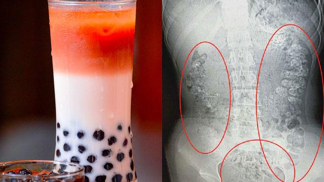 Kabızlık şikayetiyle gitti! Midesinde 100 tane bulundu