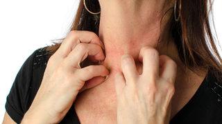 Mevsim geçişlerinde alerjik egzamaya dikkat