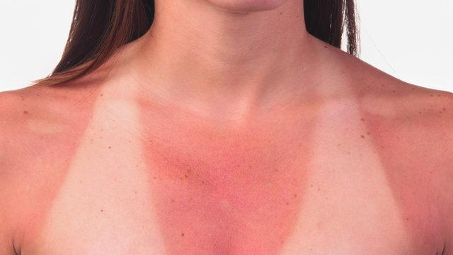 Yaz ayları geldi cilt lekelerine dikkat!