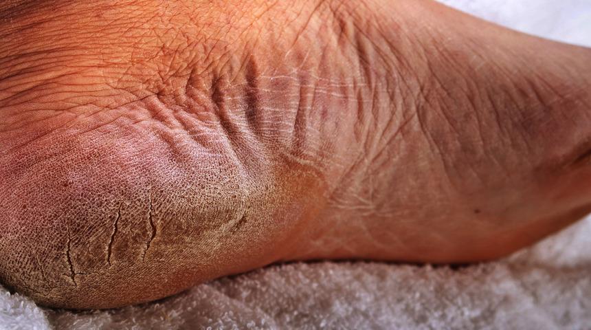 Can sıkıcı ve acı verici: topuk çatlakları! Bu doğal ilaç ile bir daha asla topuk çatlaklarınız olmayacak