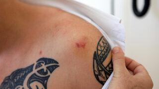 Tartıştığı kişi tarafından ısırılınca kuduz aşısı yapıldı! Akılalmaz olay