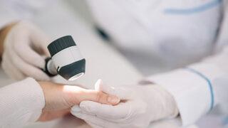 Yazın 'melanom' riskine dikkat! 