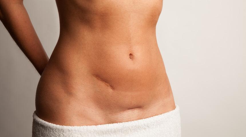 Genital bölgenizdeki kozmetik sorunlara son!