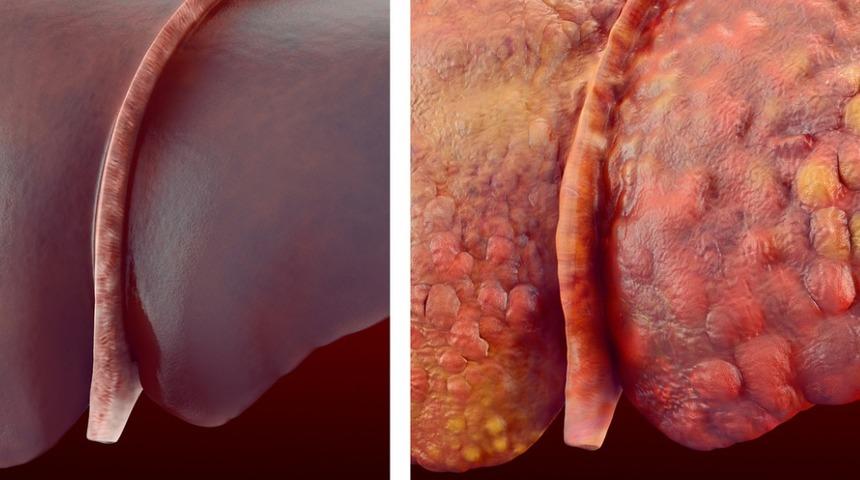 Alkol aldığınızda karaciğerinize neler olur?