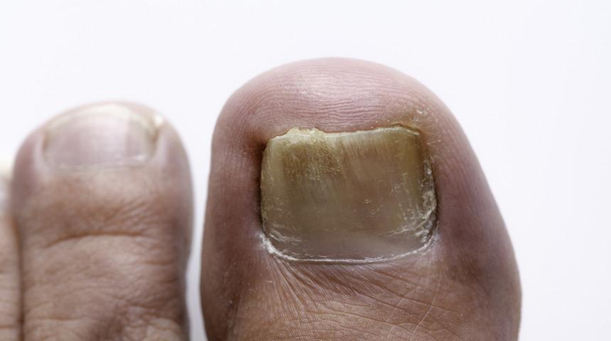 Mantar enfeksiyonundan nasıl korunabiliriz?