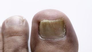 Mantar enfeksiyonundan nasıl korunabiliriz?