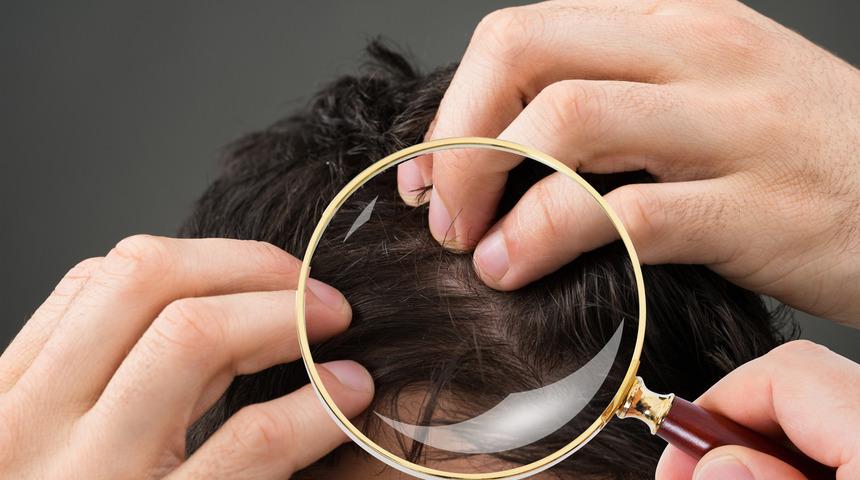 Alopesi areata nedir? Kimler görülür? Tedavi seçenekleri nelerdir?